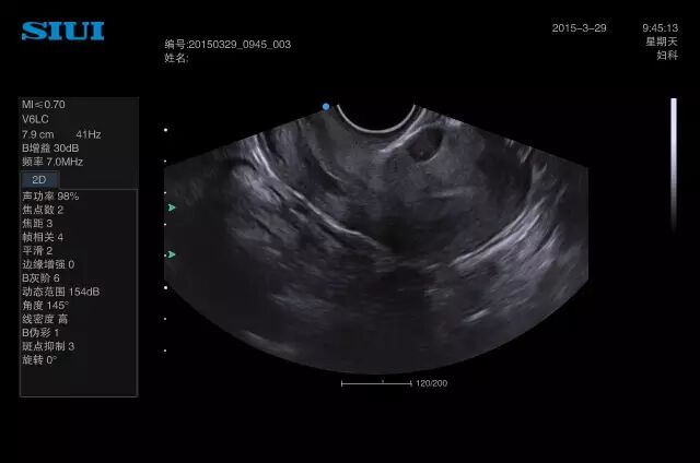 siui彩超怎么测量彩超诊断技巧汇编_https://www.jmylbn.com_新闻资讯_第4张