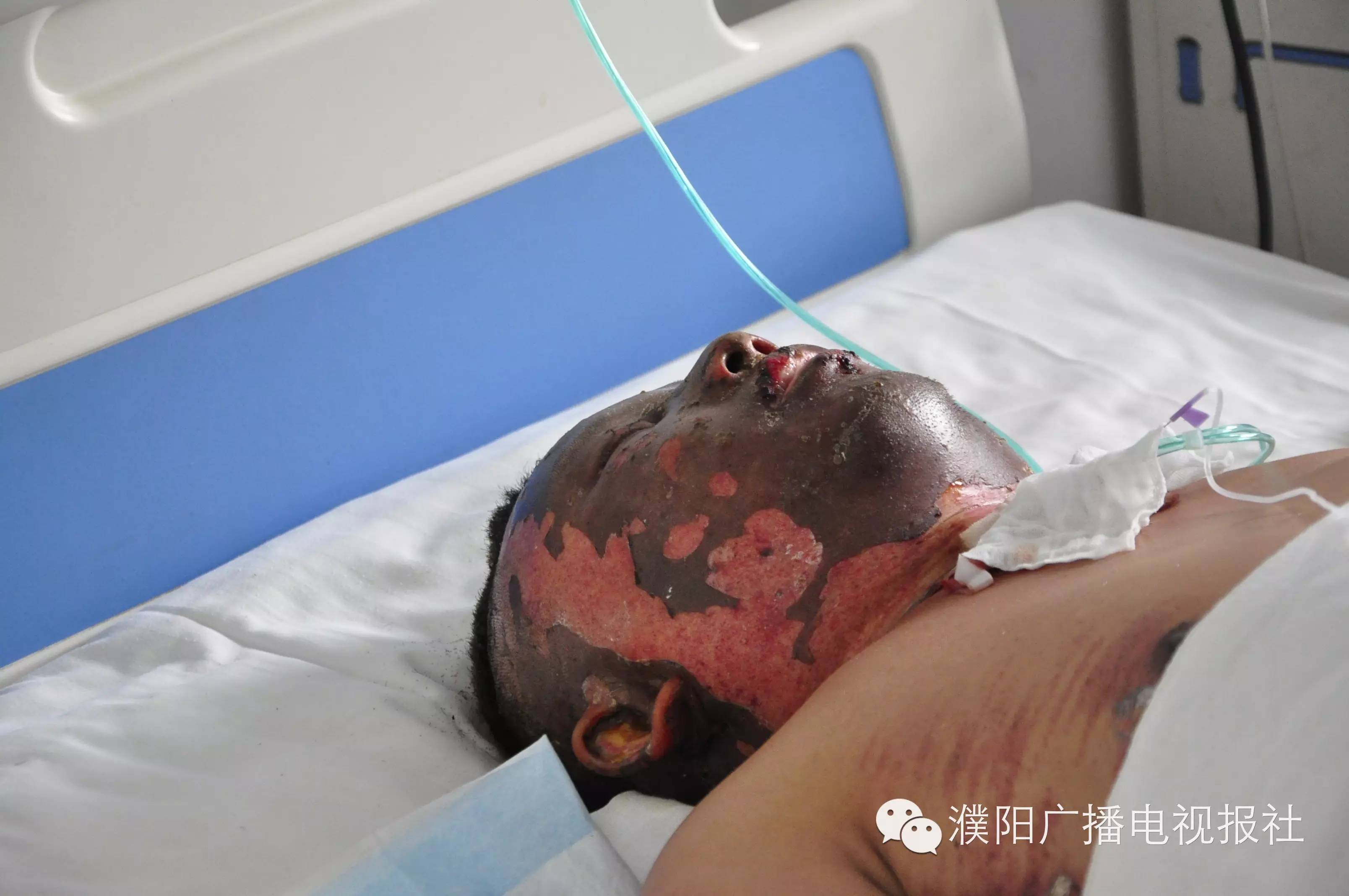 村民被火烧伤面积达50% 他从火中跑了出来 请帮他助力生命跑道 本报讯