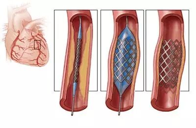 【干货】支架介入手术图文直播