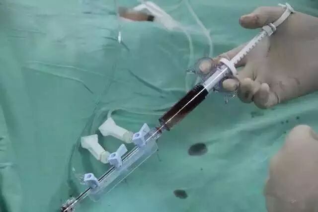 【干货】支架介入手术图文直播