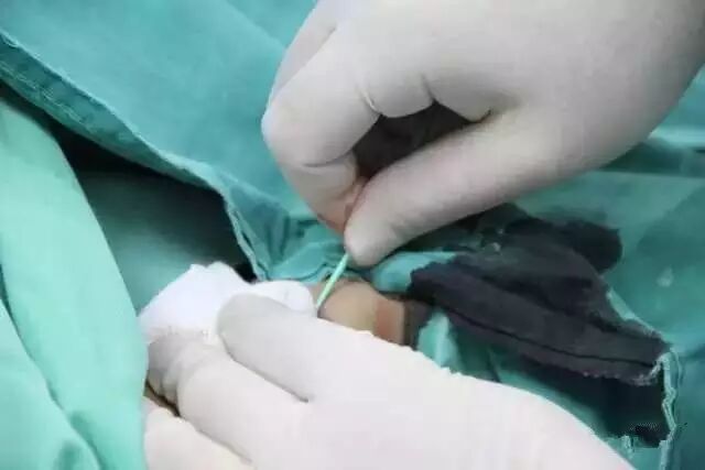 【干货】支架介入手术图文直播