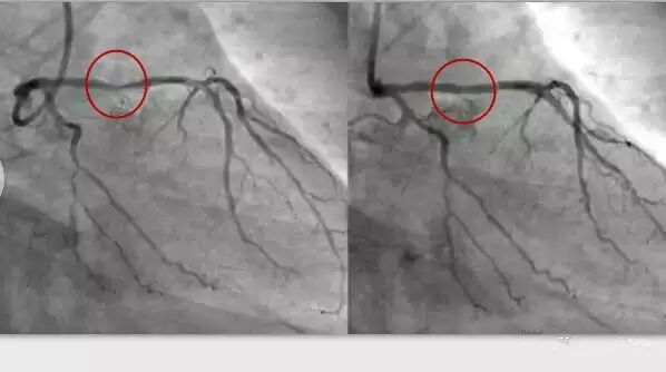 【干货】支架介入手术图文直播