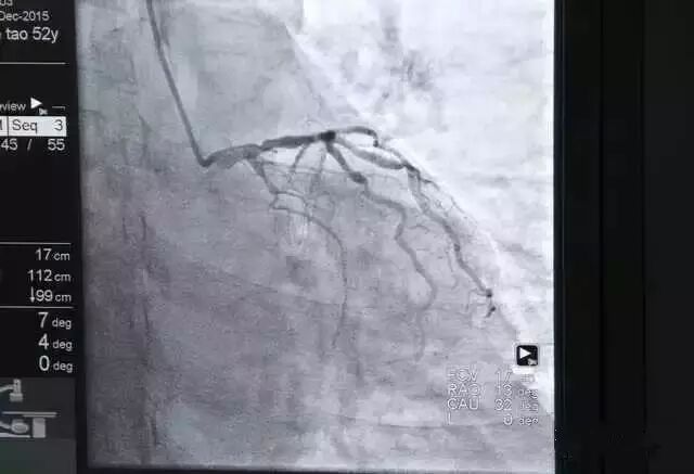 【干货】支架介入手术图文直播