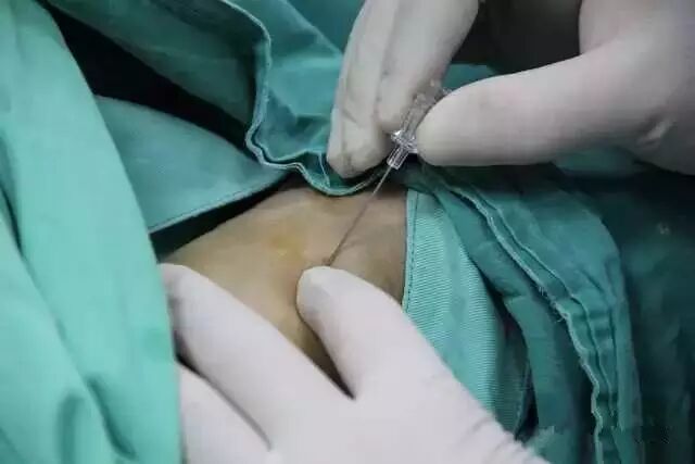 【干货】支架介入手术图文直播