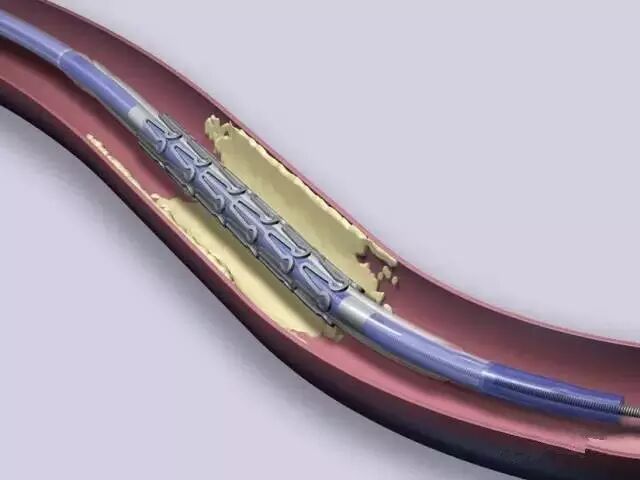 【干货】支架介入手术图文直播