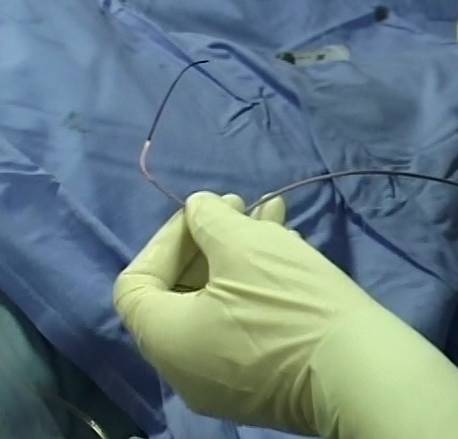 【干货】支架介入手术图文直播