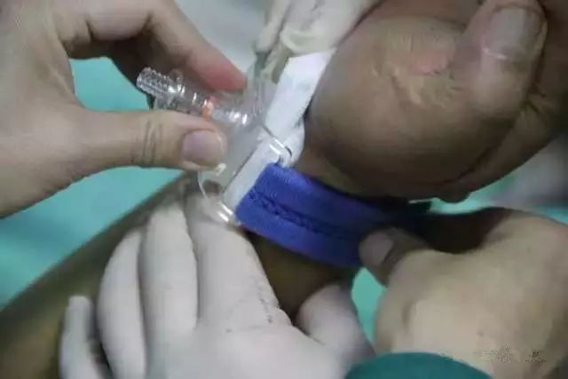 【干货】支架介入手术图文直播