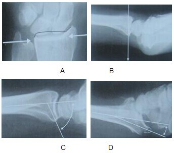 第一期 II：桡骨远端骨折之基础临床篇 - 小骨头 - 小骨头的博客