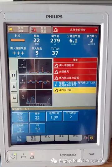 epap什么模式无创呼吸机（二）_https://www.jmylbn.com_新闻资讯_第6张