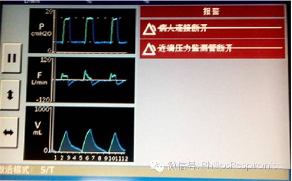 epap什么模式无创呼吸机（二）_https://www.jmylbn.com_新闻资讯_第28张