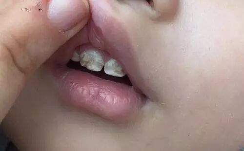 妈妈每天偷懒三分钟，孩子的牙竟成这样了！
