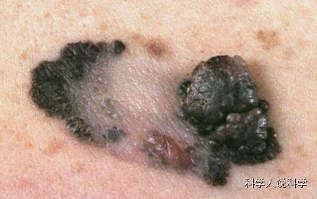 从痣到黑色素瘤的距离有多远?
