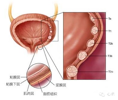 科普 膀胱肿瘤预防及早期发现的重要性