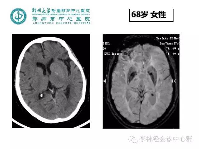 有人提出脑出血的swi高信号为t1穿透效应(t1 shine through effect)