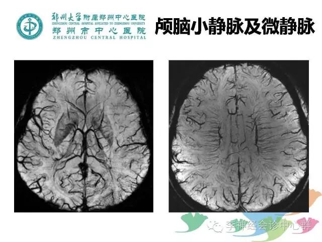 有人提出脑出血的swi高信号为t1穿透效应(t1 shine through effect)