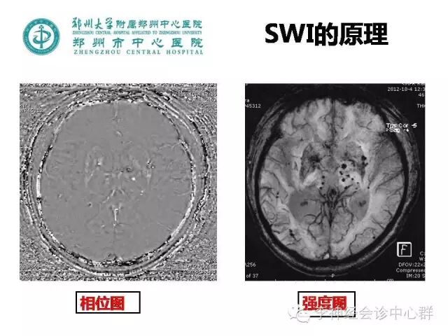 强度图中有很多低信号影,可能是出血灶