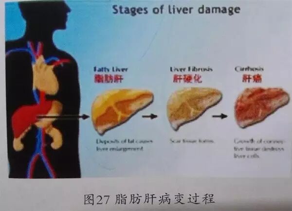 千两茶对酒精肝损伤的保护作用