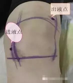 冲洗针怎么用视频膝关节冲洗技术操作视频_https://www.jmylbn.com_新闻资讯_第1张