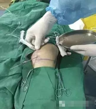 冲洗针怎么用视频膝关节冲洗技术操作视频_https://www.jmylbn.com_新闻资讯_第2张