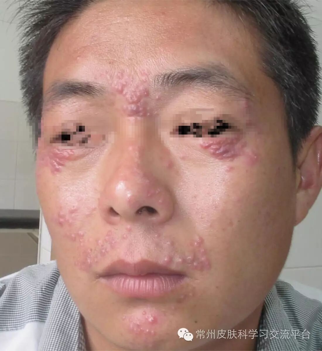 好发于面部中央,特别是鼻头及两侧,两颊,两眉间及颏部,常呈五点分布