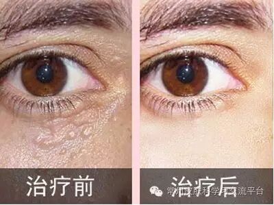 汗管瘤表皮内小汗腺导管的一种腺瘤,好发于下眼睑及颊部,颈侧,胸部