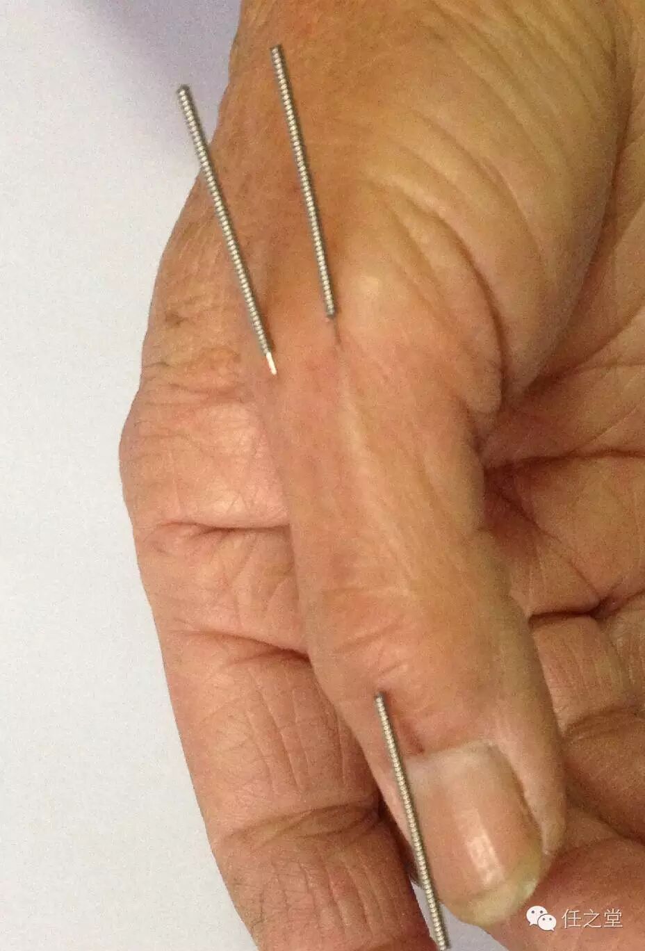 阴阳九针治病方案之一