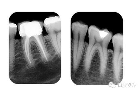 x光机为什么实用牙科X光拍摄技术与心得_https://www.jmylbn.com_新闻资讯_第1张