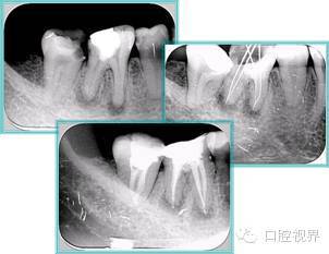 口腔H锉怎么消毒根管治疗的细节把握（细节决定成败）_https://www.jmylbn.com_新闻资讯_第21张