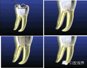 口腔H锉怎么消毒根管治疗的细节把握（细节决定成败）_https://www.jmylbn.com_新闻资讯_第4张