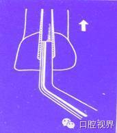 口腔H锉怎么消毒根管治疗的细节把握（细节决定成败）_https://www.jmylbn.com_新闻资讯_第15张