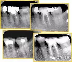 口腔H锉怎么消毒根管治疗的细节把握（细节决定成败）_https://www.jmylbn.com_新闻资讯_第24张
