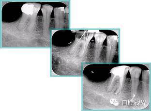 口腔H锉怎么消毒根管治疗的细节把握（细节决定成败）_https://www.jmylbn.com_新闻资讯_第30张