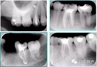 口腔H锉怎么消毒根管治疗的细节把握（细节决定成败）_https://www.jmylbn.com_新闻资讯_第19张