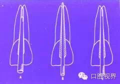 口腔H锉怎么消毒根管治疗的细节把握（细节决定成败）_https://www.jmylbn.com_新闻资讯_第7张