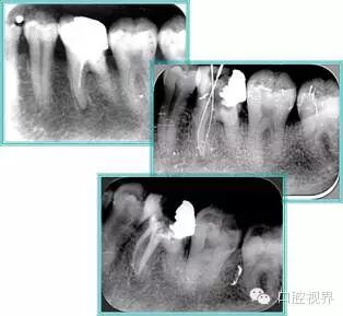 口腔H锉怎么消毒根管治疗的细节把握（细节决定成败）_https://www.jmylbn.com_新闻资讯_第25张