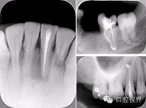口腔H锉怎么消毒根管治疗的细节把握（细节决定成败）_https://www.jmylbn.com_新闻资讯_第16张