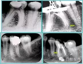 口腔H锉怎么消毒根管治疗的细节把握（细节决定成败）_https://www.jmylbn.com_新闻资讯_第29张