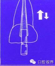 口腔H锉怎么消毒根管治疗的细节把握（细节决定成败）_https://www.jmylbn.com_新闻资讯_第13张