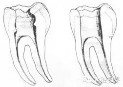 口腔H锉怎么消毒根管治疗的细节把握（细节决定成败）_https://www.jmylbn.com_新闻资讯_第5张