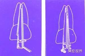 口腔H锉怎么消毒根管治疗的细节把握（细节决定成败）_https://www.jmylbn.com_新闻资讯_第14张