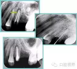 口腔H锉怎么消毒根管治疗的细节把握（细节决定成败）_https://www.jmylbn.com_新闻资讯_第27张