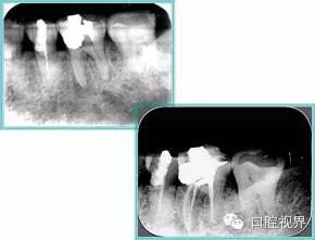 口腔H锉怎么消毒根管治疗的细节把握（细节决定成败）_https://www.jmylbn.com_新闻资讯_第22张