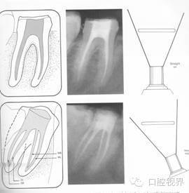口腔H锉怎么消毒根管治疗的细节把握（细节决定成败）_https://www.jmylbn.com_新闻资讯_第17张