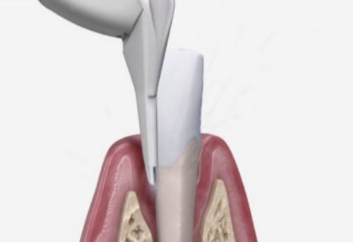 牙科喷砂枪怎么用洁牙只用超声？你out了！_https://www.jmylbn.com_新闻资讯_第3张