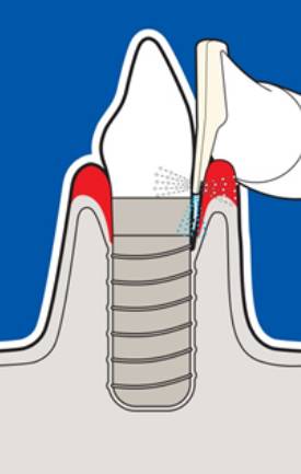 牙科喷砂枪怎么用洁牙只用超声？你out了！_https://www.jmylbn.com_新闻资讯_第2张