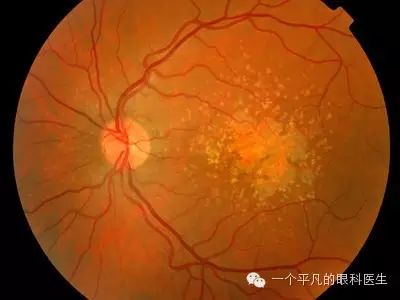 眼底检查双眼黄斑区色素紊乱,中心凹光反射消失,后极部有时常可见到
