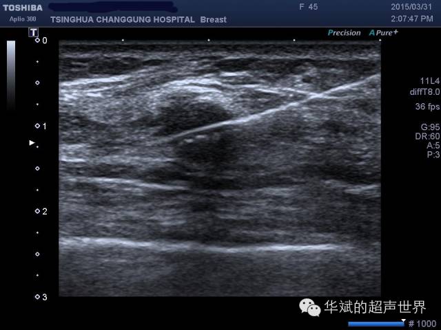 穿刺枪怎么升级乳腺穿刺术（二）_https://www.jmylbn.com_新闻资讯_第5张