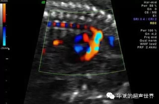 彩超伪像是什么超声伪像：折射伪像_https://www.jmylbn.com_新闻资讯_第4张