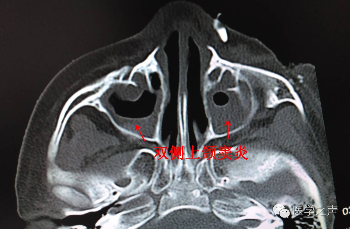 鼻窦炎主要ct表现:窦腔内见软组织密度影(红色箭头).
