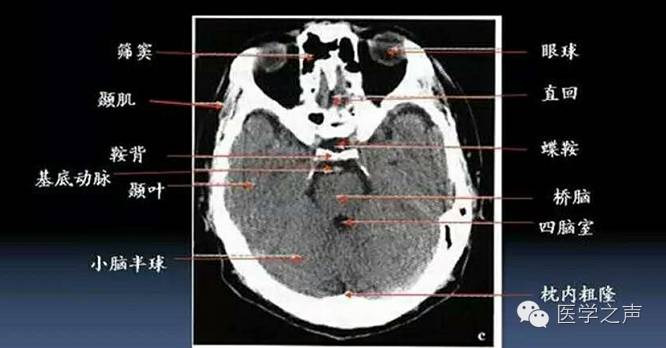 本病例初步诊断:左侧颞骨,枕骨骨折.